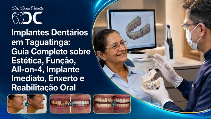 Implantes Dentários em Taguatinga: Guia Completo sobre Estética, Função, All-on-4, Implante Imediato, Enxerto e Reabilitação Oral